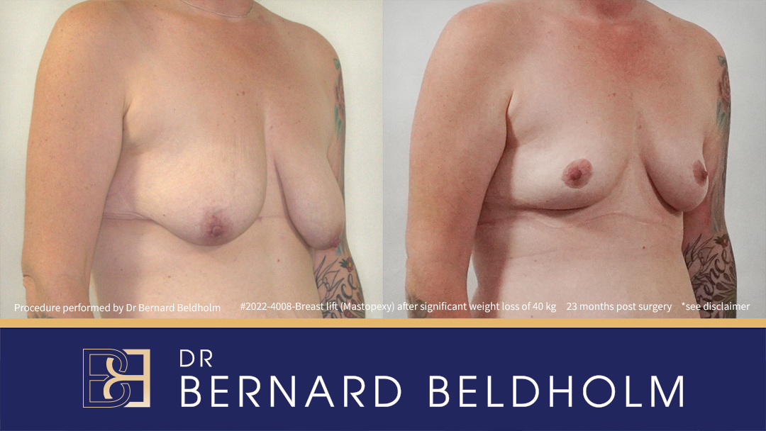 Mastopexy (Breast Lift) Patient 2022-4008 2 Mastopexy (Breast Lift) Patient 2022-4008 - Left