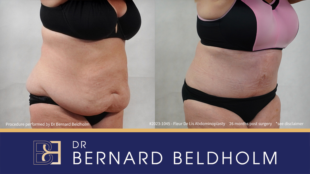 Fleur-de-Lis Abdominoplasty and Upper Abdominal Lipectomy Post Weight Loss (Patient 2023-1045) - Left