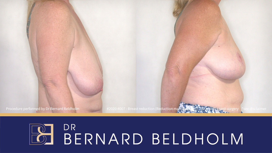 Breast Reduction (Reduction Mammoplasty) for F Cup Uneven Breasts (Patient 2020-4007) - Left Side