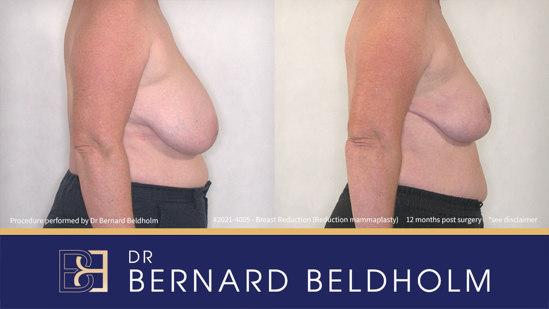 Reduction Mammoplasty (Breast Reduction) Patient 2021-4005 3 Reduction Mammoplasty (Breast Reduction) Patient 2021-4005 - Left Side