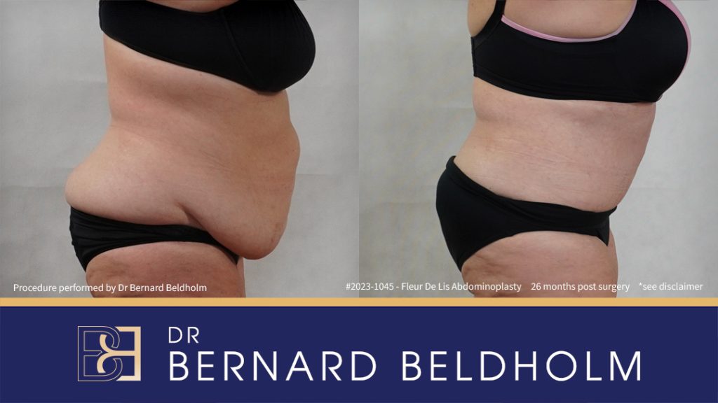 Fleur-de-Lis Abdominoplasty and Upper Abdominal Lipectomy Post Weight Loss (Patient 2023-1045) - Left Side