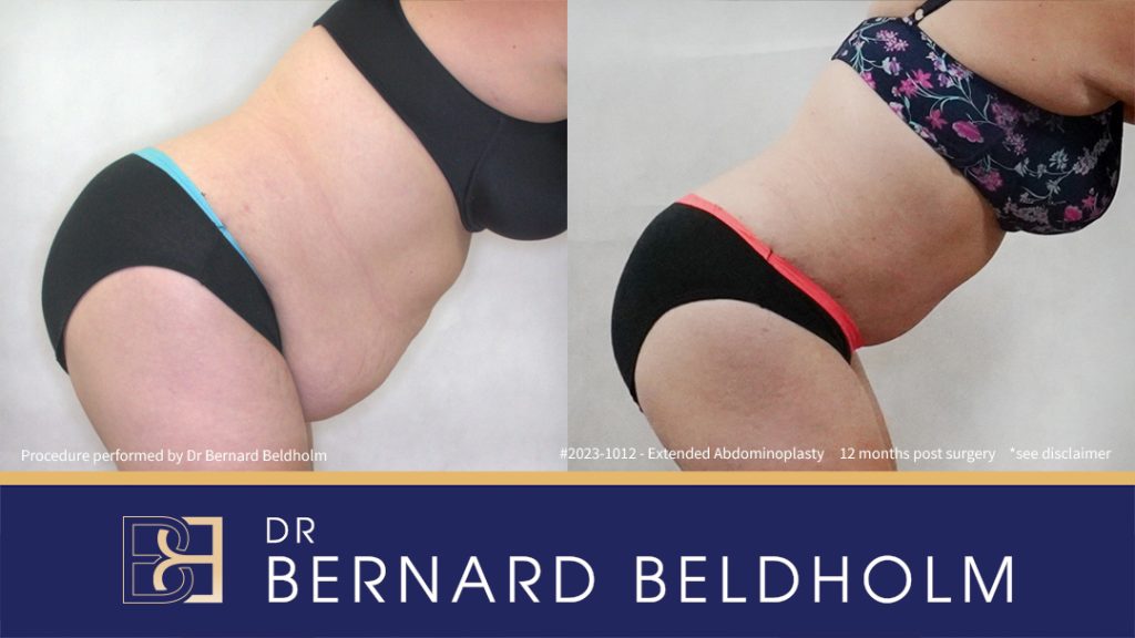 Abdominoplasty Post Weight Loss and Post Pregnancy, Including Repair of Diastasis Recti and VASER liposuction (Patient 2023-1012) - Left Side Bend