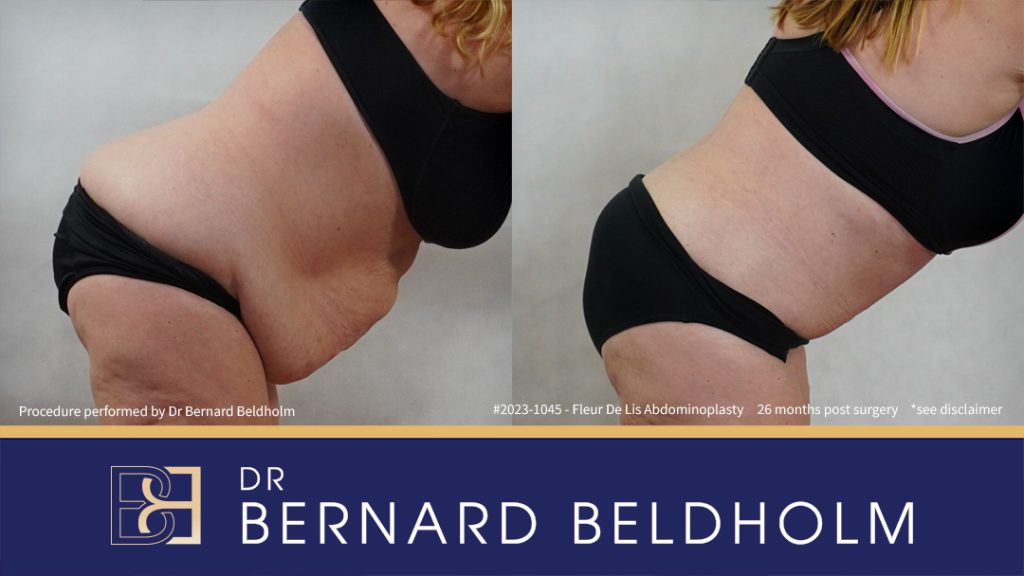 Fleur-de-Lis Abdominoplasty and Upper Abdominal Lipectomy Post Weight Loss (Patient 2023-1045) - Left Side Bend