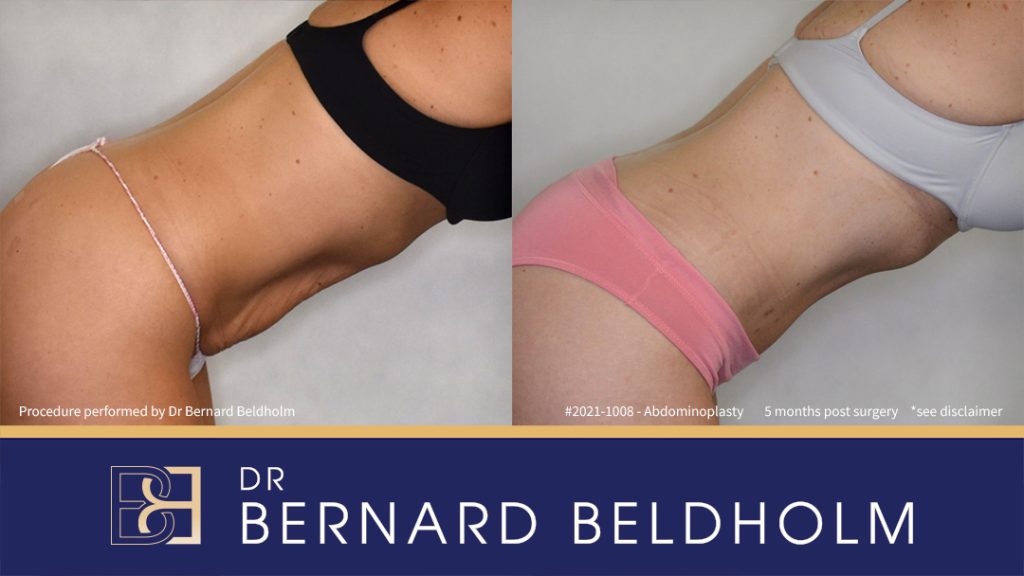 Abdominoplasty Post Weight Loss Patient 2021-1008 - Left Bend