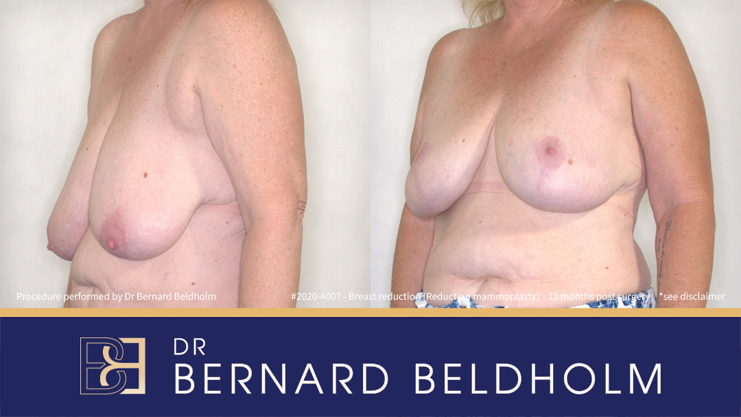 Breast Reduction (Reduction Mammoplasty) for F Cup Uneven Breasts (Patient 2020-4007) - Right