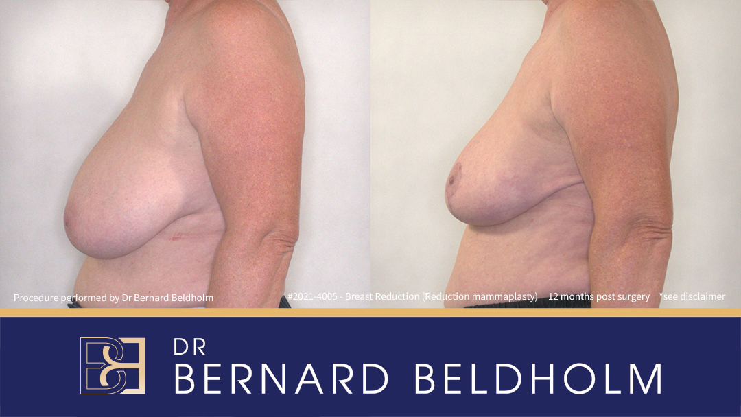 Reduction Mammoplasty (Breast Reduction) Patient 2021-4005 5 Reduction Mammoplasty (Breast Reduction) Patient 2021-4005 - Right Side