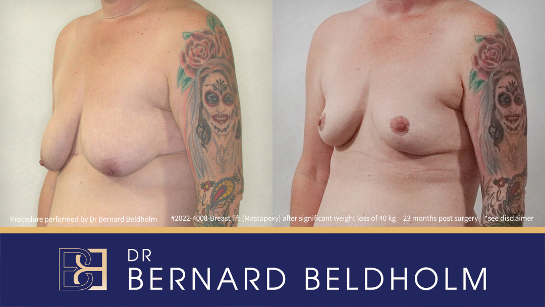 Mastopexy (Breast Lift) Patient 2022-4008 5 Mastopexy (Breast Lift) Patient 2022-4008 - Right