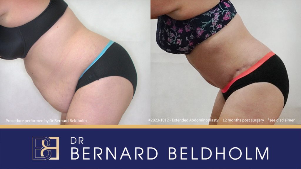 Abdominoplasty Post Weight Loss and Post Pregnancy, Including Repair of Diastasis Recti and VASER liposuction (Patient 2023-1012) - Right Side Bend