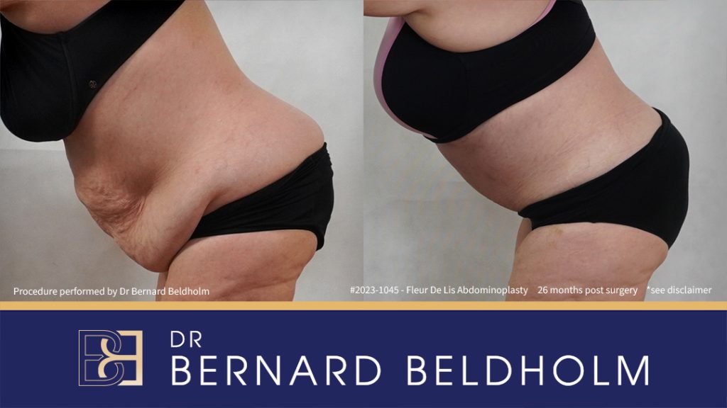 Fleur-de-Lis Abdominoplasty and Upper Abdominal Lipectomy Post Weight Loss (Patient 2023-1045) - Right Side Bend