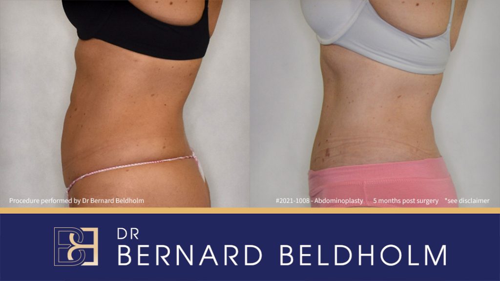 Abdominoplasty Post Weight Loss Patient 2021-1008 - Right Side