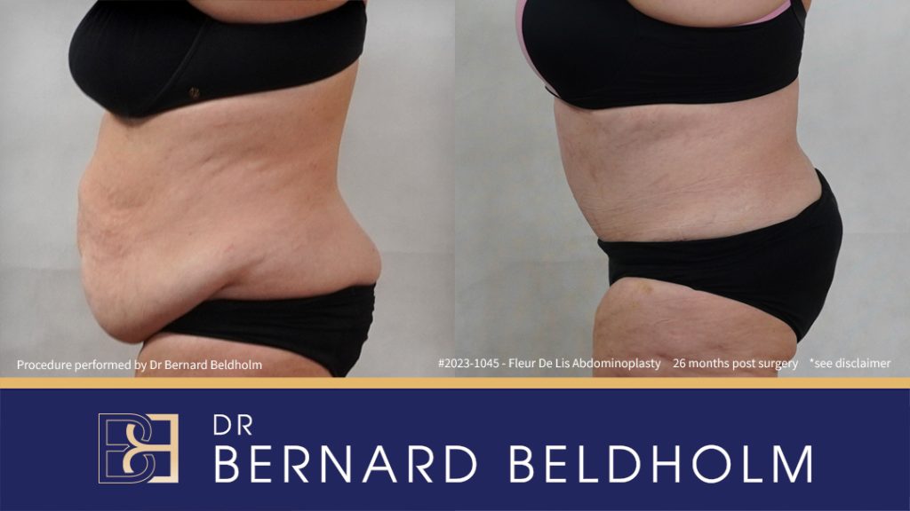 Fleur-de-Lis Abdominoplasty and Upper Abdominal Lipectomy Post Weight Loss (Patient 2023-1045) - Right Side