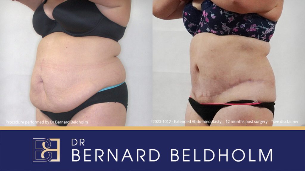 Abdominoplasty Post Weight Loss and Post Pregnancy, Including Repair of Diastasis Recti and VASER liposuction (Patient 2023-1012) - Right