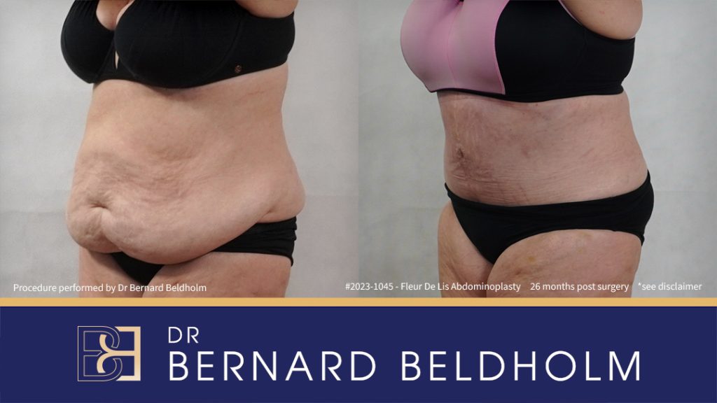 Fleur-de-Lis Abdominoplasty and Upper Abdominal Lipectomy Post Weight Loss (Patient 2023-1045) - Right