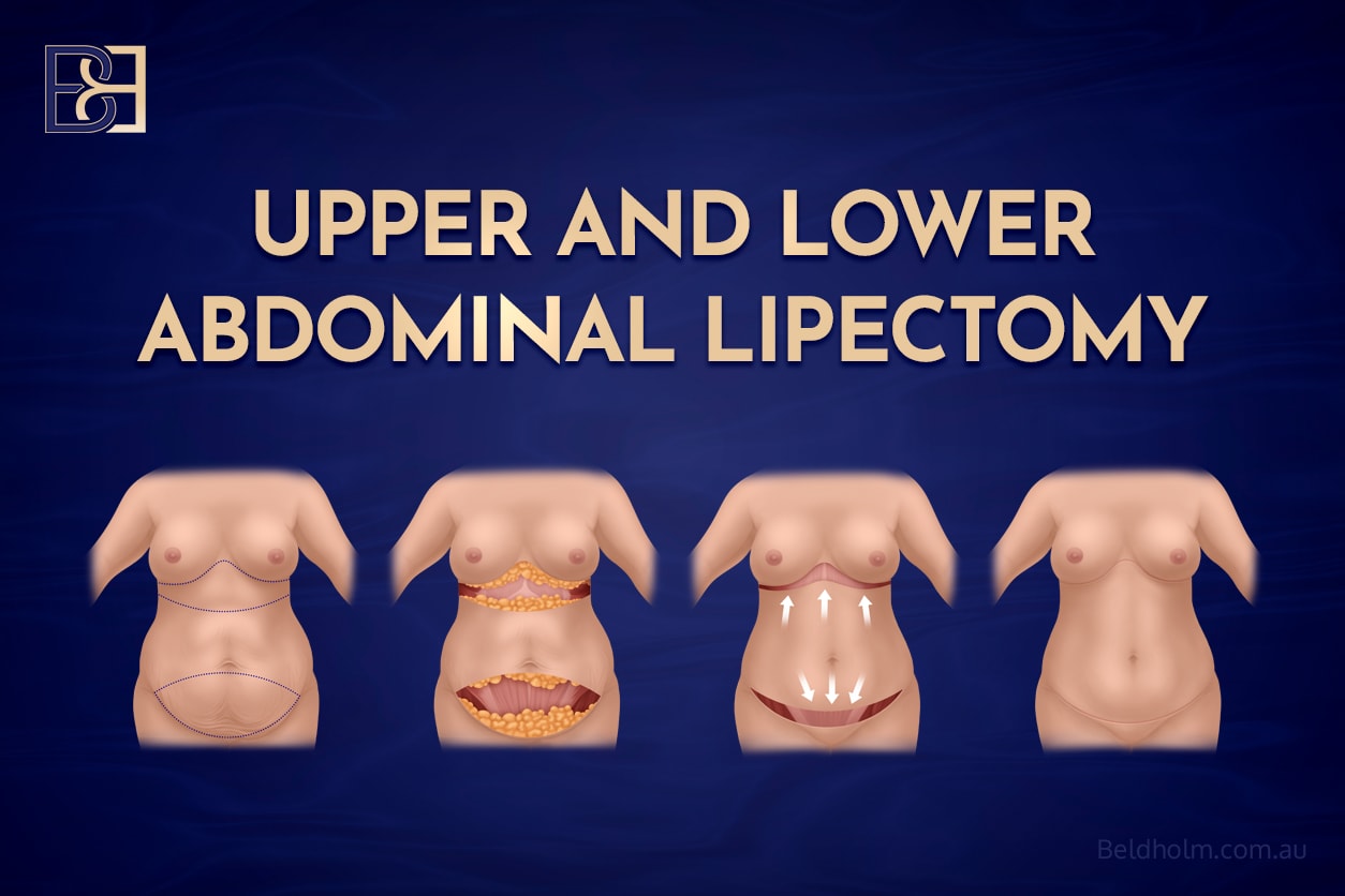 Complications for Upper and Lower Abdominal Lipectomy Post Weight Loss 1 Upper and lower lipectomy | Dr Bernard Beldholm