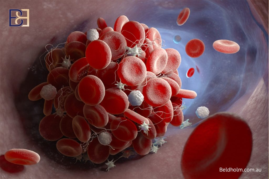 Brachioplasty (Arm Lift) Post Weight Loss 15 Blood Clots