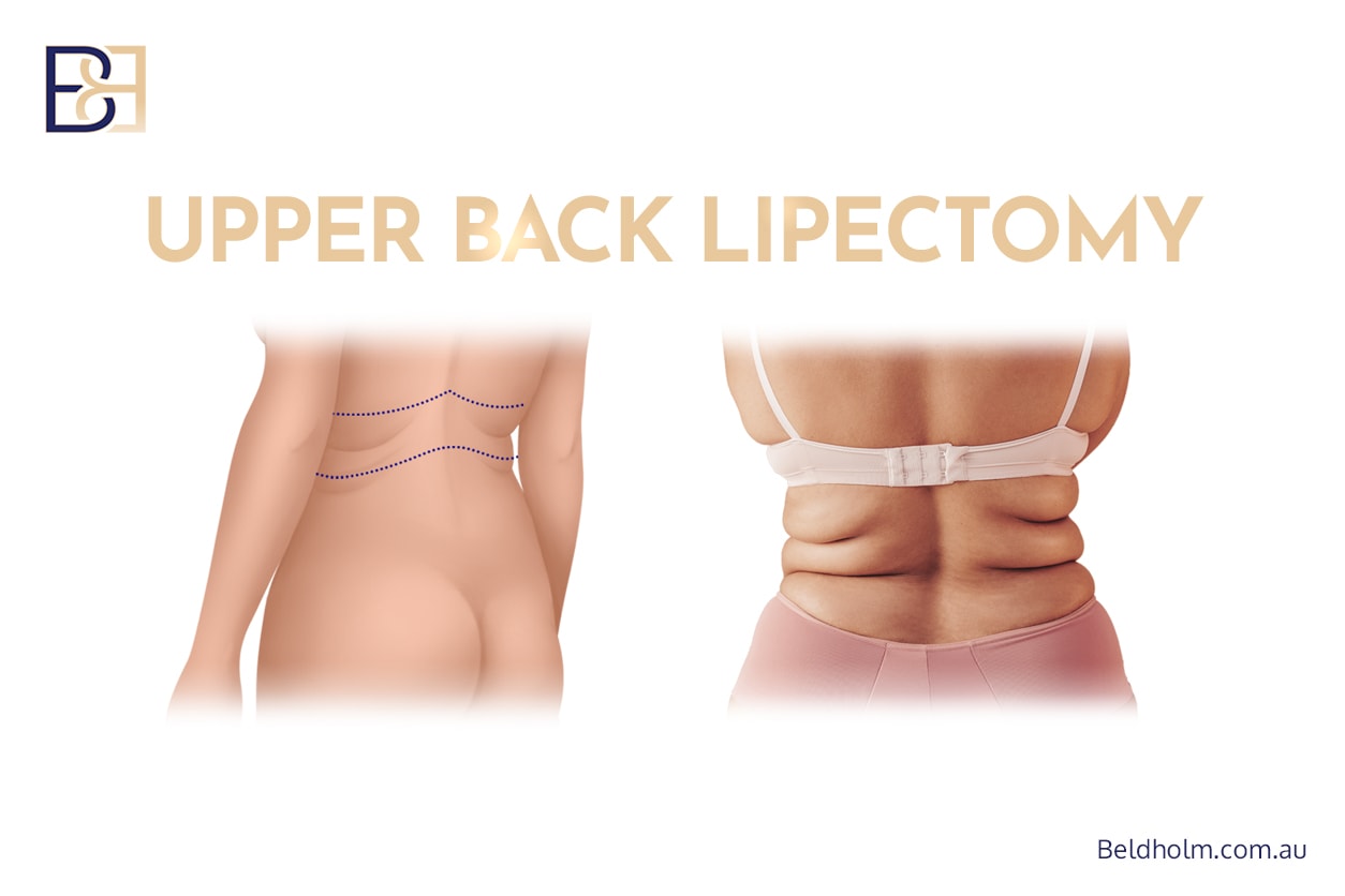Complications from Bra Lift (Upper Back Lipectomy) post weight loss 1 5d1b9933 5ee8 4c77 b98e abbbbdb7753d