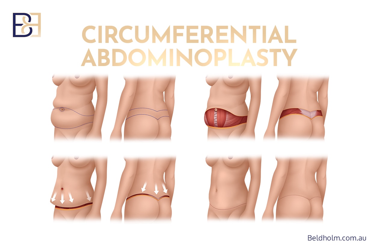 Complications of Circumferential Hybrid Abdominoplasty (Combined Vertical with Circumferential Abdominoplasty) 4 Circumferential abdominoplasty | Dr Bernard Beldholm