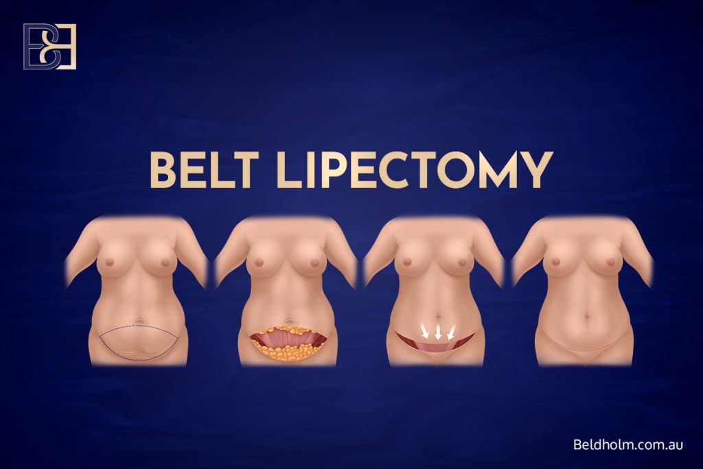 Upper and Lower Abdominal Lipectomy Post Weight Loss, a Highly Selective Body Contouring Option for Uncommon Anatomical Patterns 4 Belt Lipectomy