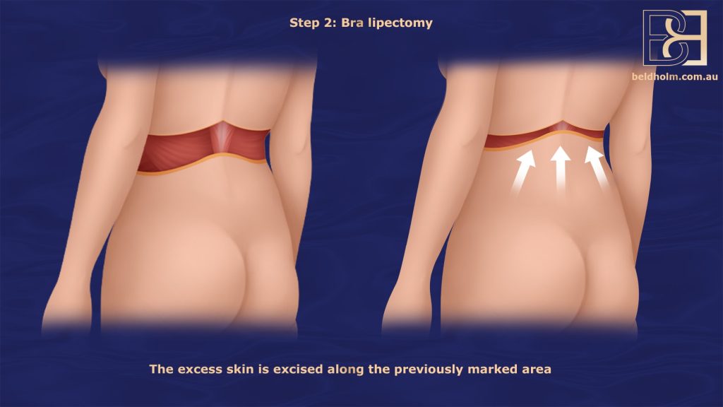 Bra Lipectomy - Excision of Skin in the Bra Strap Area