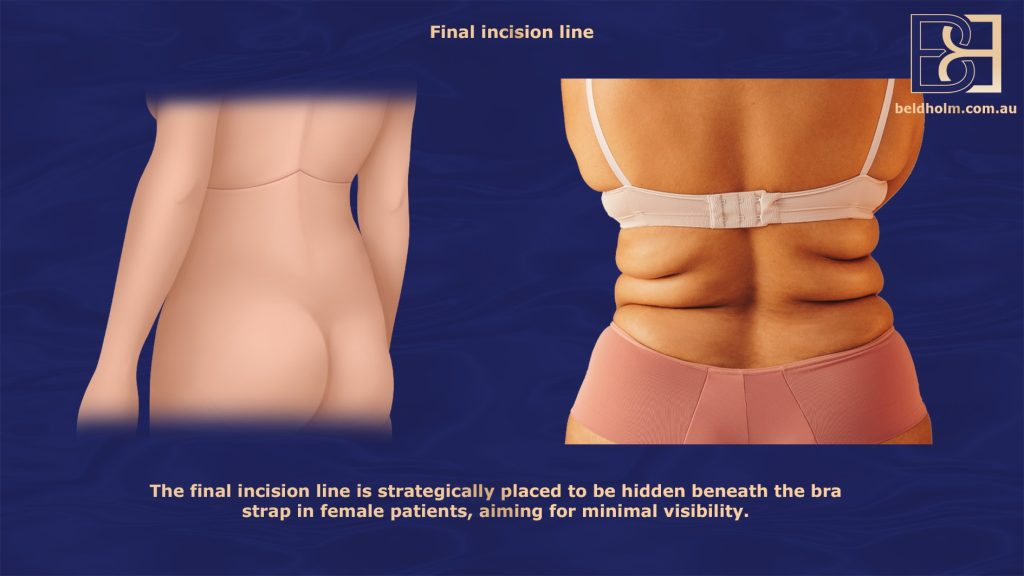 Bra Lipectomy - Final Incsion Line