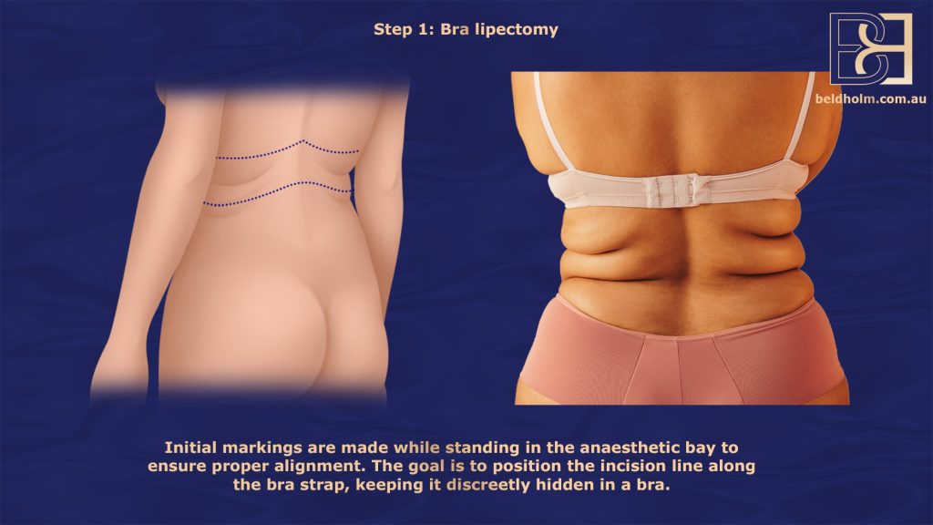 Bra Lipectomy Marking the Incision