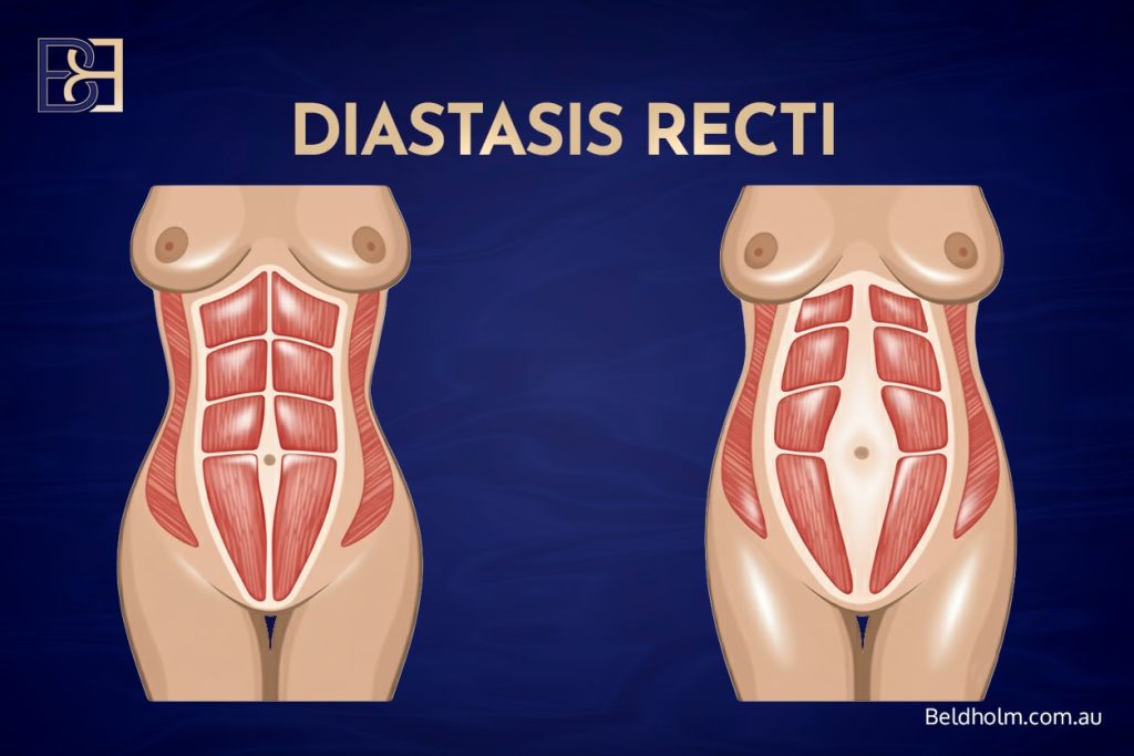 Recovering from Dual-Vector Abdominoplasty 6 Diastasis Recti