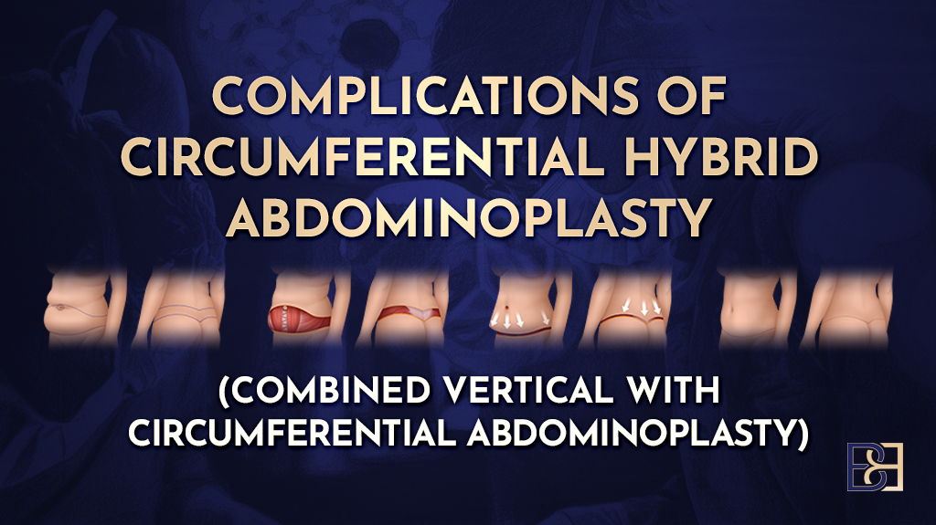 Complications of Circumferential Hybrid Abdominoplasty (Combined vertical with circumferential abdominoplasty)