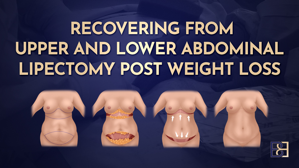 Recovering from Upper and Lower Abdominal Lipectomy After Significant Weight Loss