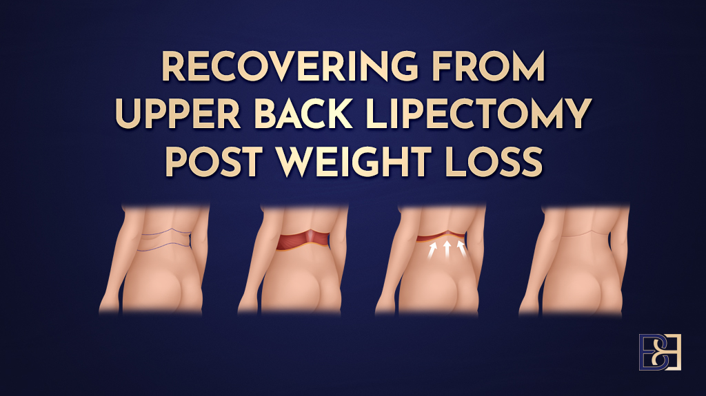Recovering From a Bra Lipectomy (Bra Line Back Lift) (upper back lipectomy)