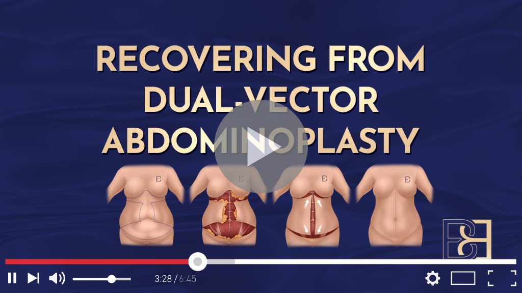 Recovering from Dual-Vector Abdominoplasty 1 Recovering from Dual-Vector Abdominoplasty