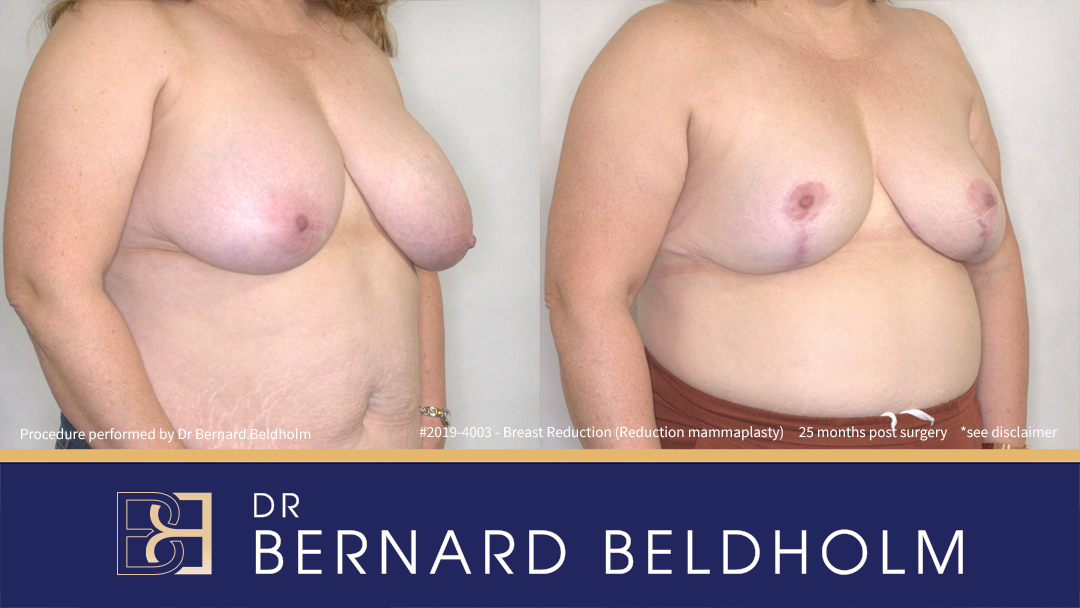 Breast Reduction (Reduction Mammoplasty) for F Cup (Patient 2019-4003) - Left