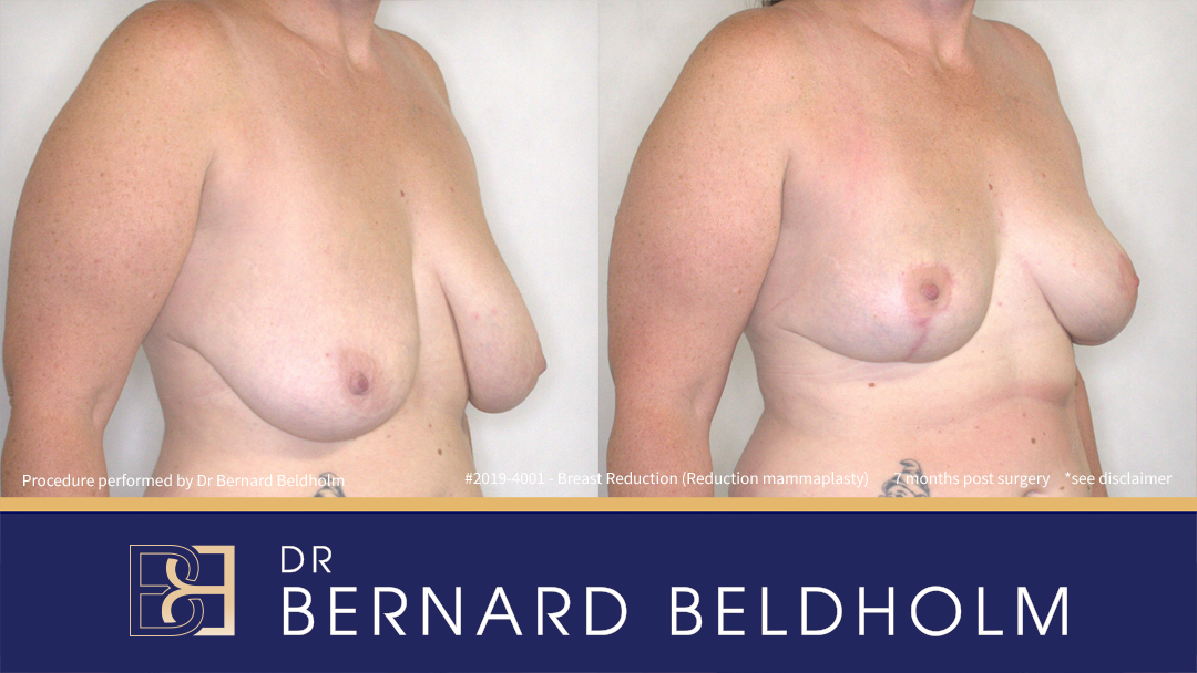 Reduction Mammoplasty (Breast Reduction) Patient 2019-4001 2 Breast Reduction (Reduction Mammoplasty) for E Cup Uneven Breasts (Patient 2019-4001) - Left