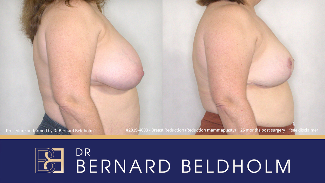 Breast Reduction (Reduction Mammoplasty) for F Cup (Patient 2019-4003) - Left Side