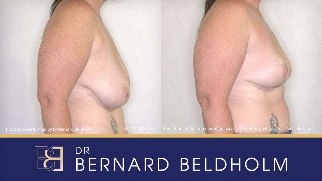 Reduction Mammoplasty (Breast Reduction) Patient 2019-4001 3 Breast Reduction (Reduction Mammoplasty) for E Cup Uneven Breasts (Patient 2019-4001) - Left Side