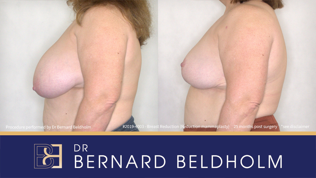 DrBB Website 4 Patient 2019 4003 Breast Reduction Before After