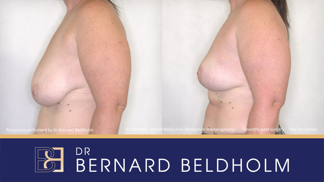 Reduction Mammoplasty (Breast Reduction) Patient 2019-4001 4 DrBB Website 4 Patient 2019 4001 Breast Reduction Before After