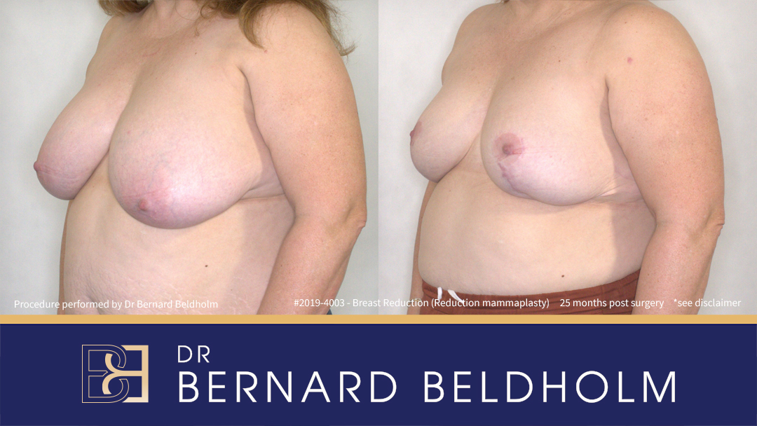 Breast Reduction (Reduction Mammoplasty) for F Cup (Patient 2019-4003) - Right
