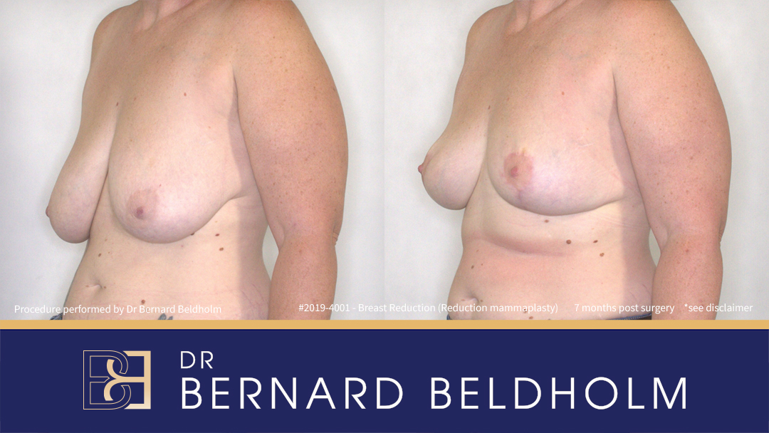 Reduction Mammoplasty (Breast Reduction) Patient 2019-4001 5 Breast Reduction (Reduction Mammoplasty) for E Cup Uneven Breasts (Patient 2019-4001) - Right