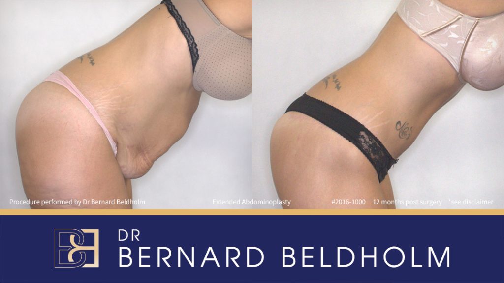 Abdominoplasty Post Weight Loss Patient 2016-1000 4 Extended Abdominoplasty (Tummy Tuck) After 50kg of Weight Loss (Patient 2016-1000) - Left Side Bend