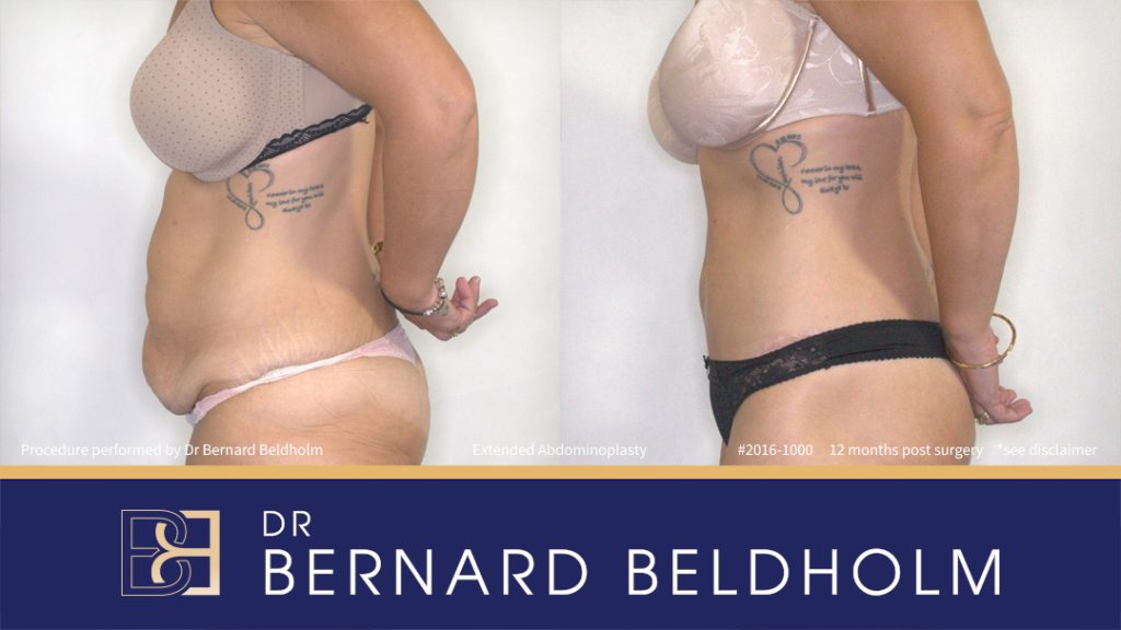 Abdominoplasty Post Weight Loss Patient 2016-1000 6 Extended Abdominoplasty (Tummy Tuck) After 50kg of Weight Loss (Patient 2016-1000) - Right Side
