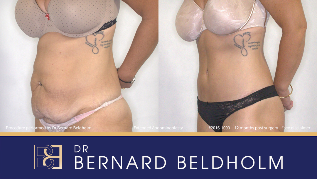 Abdominoplasty Post Weight Loss Patient 2016-1000 7 Extended Abdominoplasty (Tummy Tuck) After 50kg of Weight Loss (Patient 2016-1000) - Right