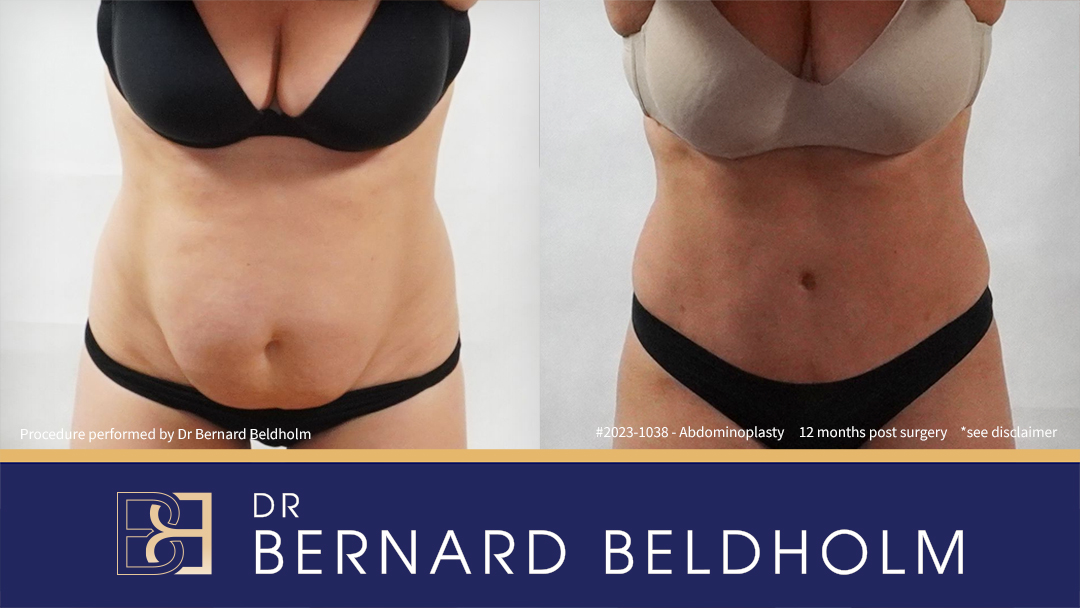 Abdominoplasty Post Pregnancy Patient 2023-1038 5 Abdominoplasty with VASER Liposuction (Suction-assisted Lipectomy) and Diastasis Recti Repair | 12 Months Post Surgery | Patient 2023-1038 - Front Bend