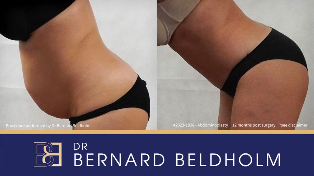 Abdominoplasty Post Pregnancy Patient 2023-1038 6 Abdominoplasty with VASER Liposuction (Suction-assisted Lipectomy) and Diastasis Recti Repair | 12 Months Post Surgery | Patient 2023-1038 - Right Side Bend