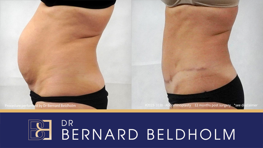 Abdominoplasty Post Pregnancy Patient 2023-1038 7 Abdominoplasty with VASER Liposuction (Suction-assisted Lipectomy) and Diastasis Recti Repair | 12 Months Post Surgery | Patient 2023-1038 - Right Side