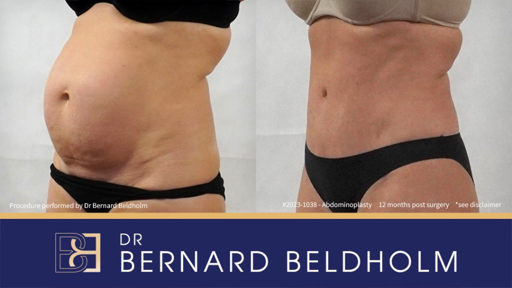 Abdominoplasty Post Pregnancy Patient 2023-1038 8 Abdominoplasty with VASER Liposuction (Suction-assisted Lipectomy) and Diastasis Recti Repair | 12 Months Post Surgery | Patient 2023-1038 - Right
