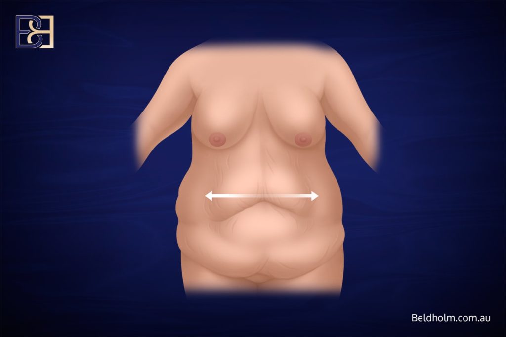 Horizontal excess skin