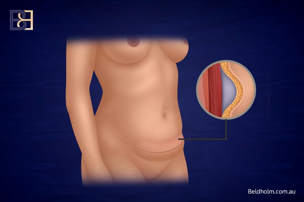 Seroma Formation
