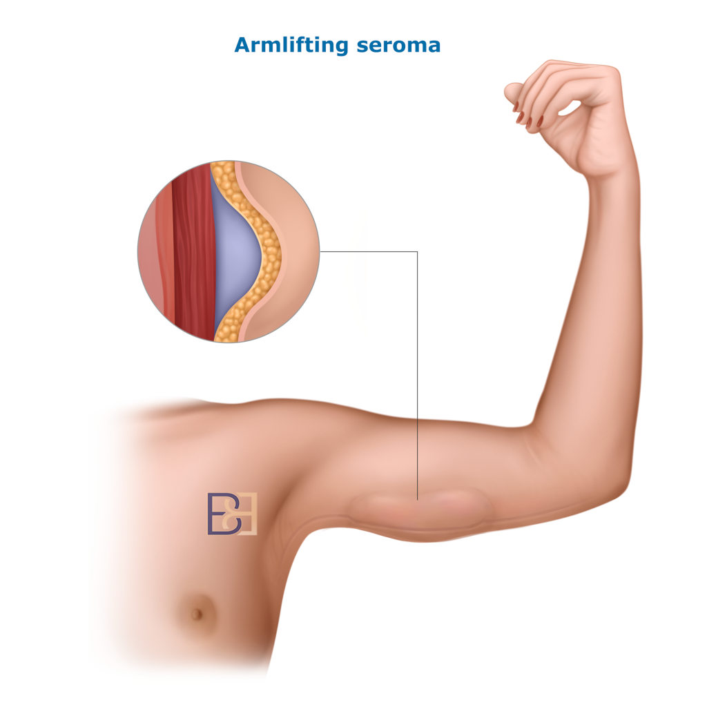 Seroma and Fluid Accumulation