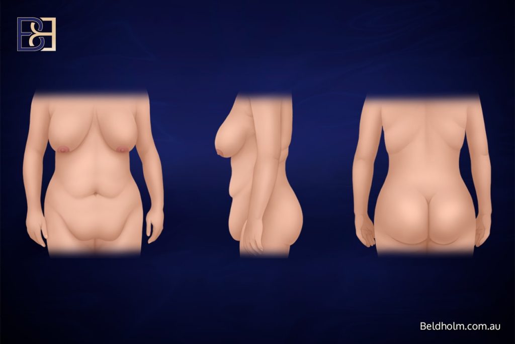 Upper and Lower Abdominal Lipectomy Post Weight Loss, a Highly Selective Body Contouring Option for Uncommon Anatomical Patterns 3 Skin changes after major weight loss