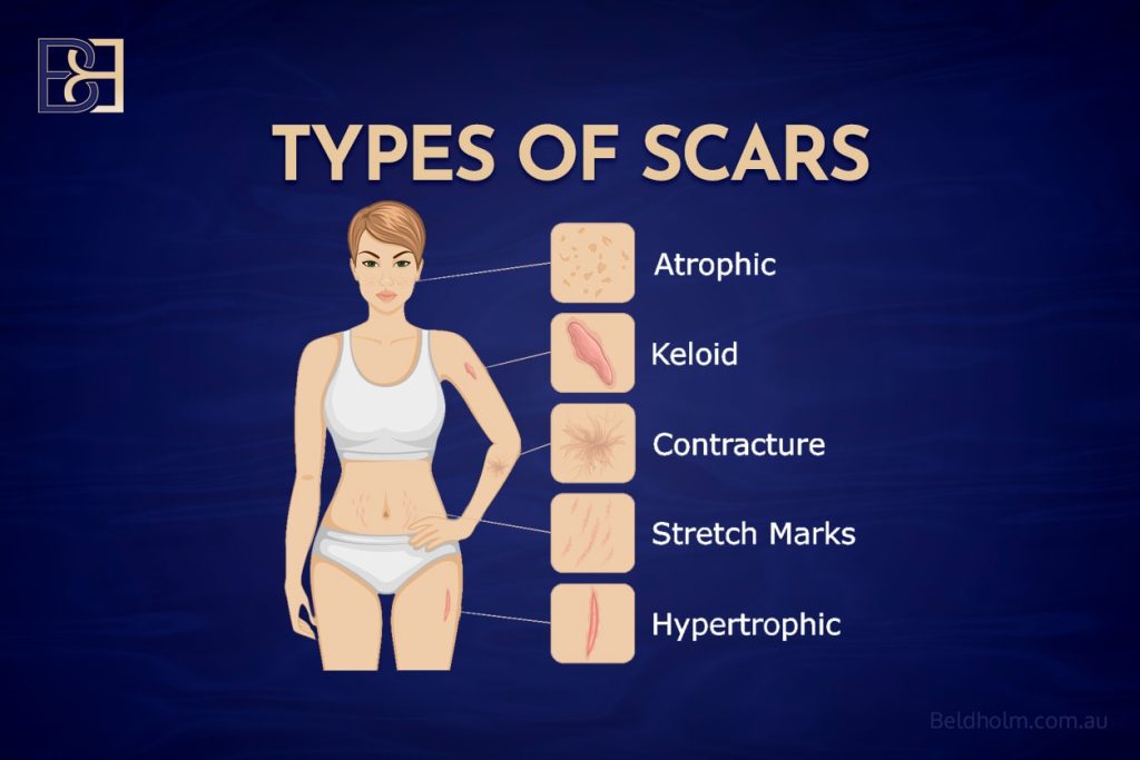 Types of scars